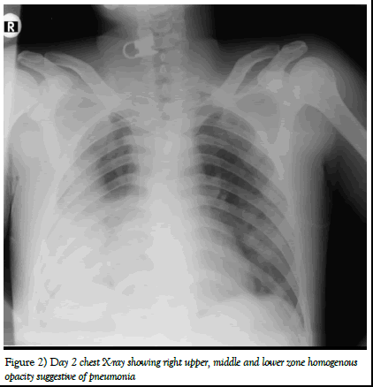 pulmtcr-x ray pulmtcr-x ray